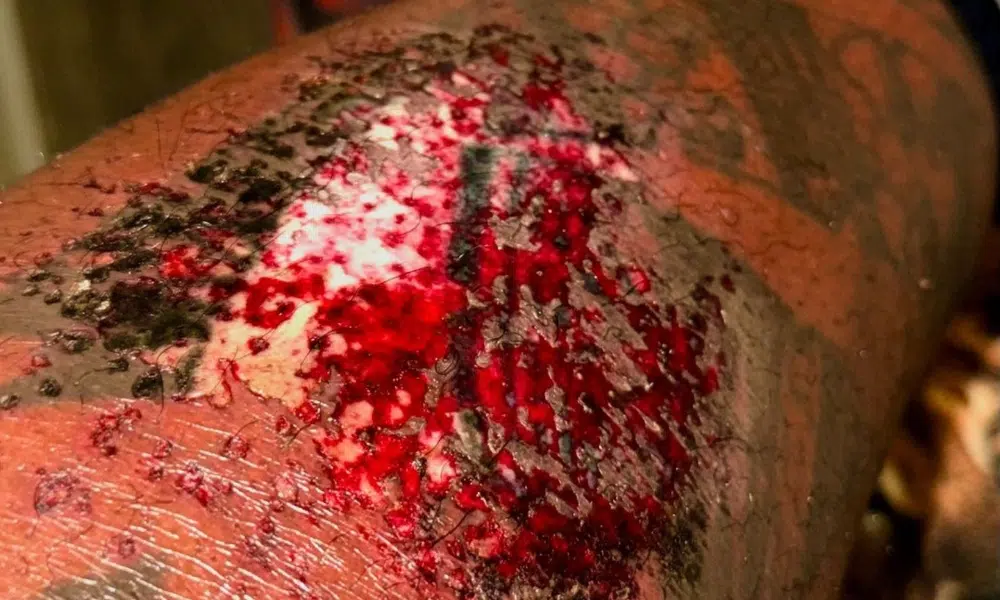 Tonio Burton Blessure 2 Tonio Burton Blessure 2