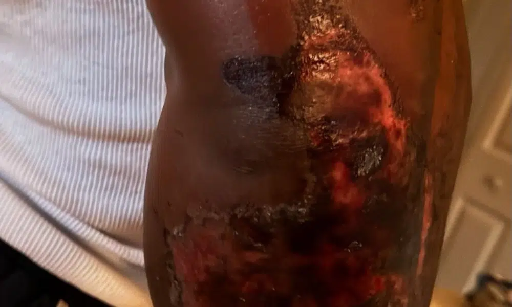 Blessure de Tonio Burton Blessure de Tonio Burton