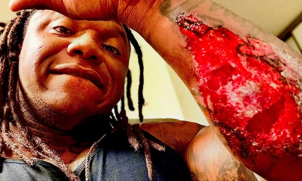 Tonio Burton Blessure 3 Tonio Burton Blessure 3