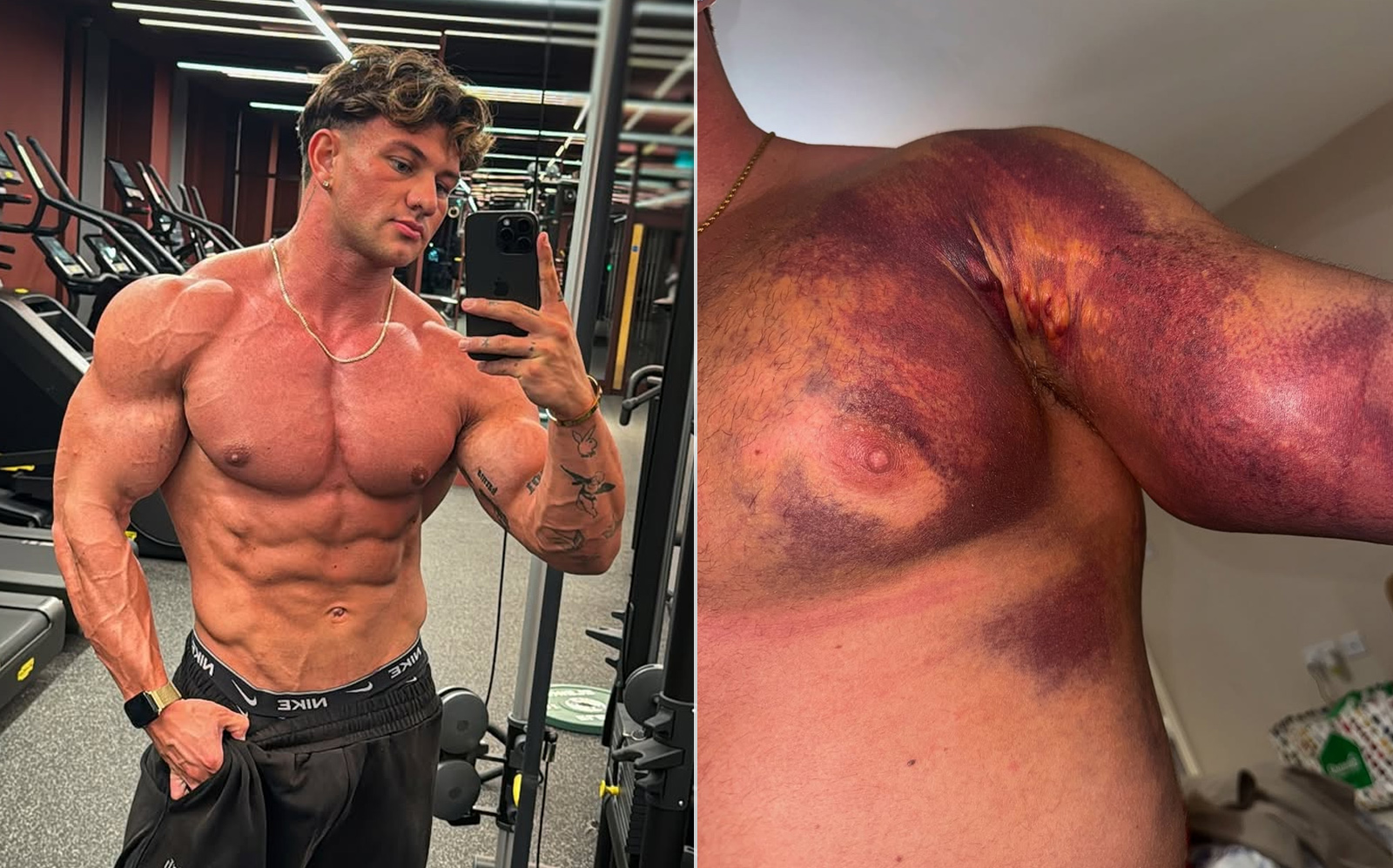 Déchirure brutale de Pec de Tristan Barnes: deux chirurgies, les revers et le côté obscur de la musculation - Fitness Volt